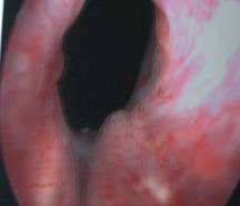 Cystoscopic view of bladder neck in incontinent patient